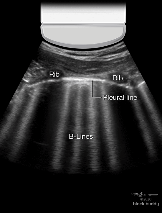 Lung Ultrasound B Lines
