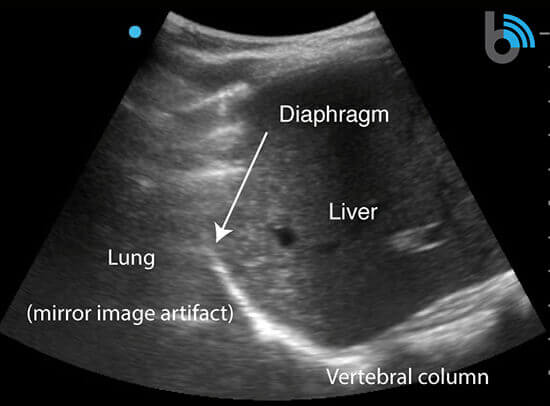 Lung Ultrasound
