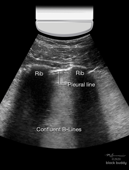 Lung Ultrasound 14a Confluent B-Lines