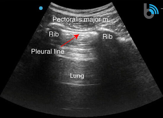 Lung Ultrasound Sonoantomy-Curved
